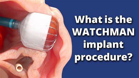 What is the WATCHMAN implant procedure? - YouTube