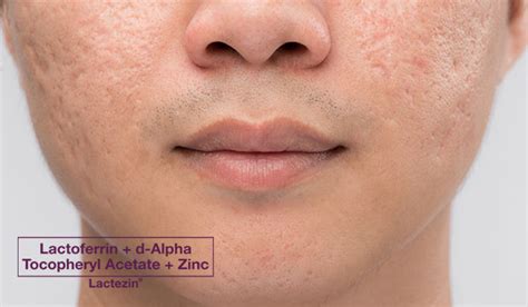 5 Types of Pimple Scars - Lactezin