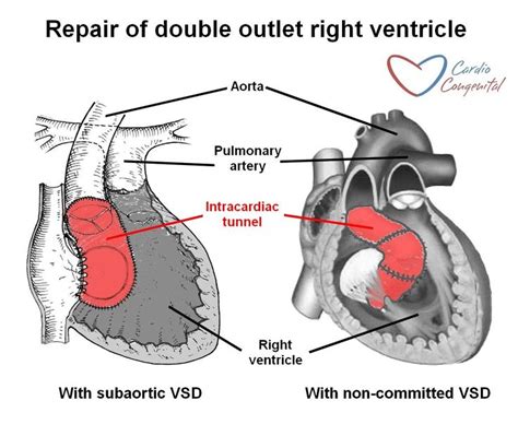 9 best Double Chamber Right Ventricle (DCRV) images on Pinterest | Baby ...