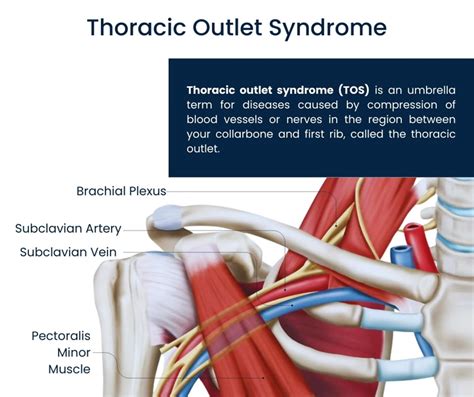 Thoracic Outlet Syndrome Treatment NYC | Pain Management NYC