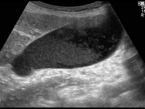 Abdomen and retroperitoneum | 1.3 Pancreas : Case 1.3.1 Pancreatic head ...