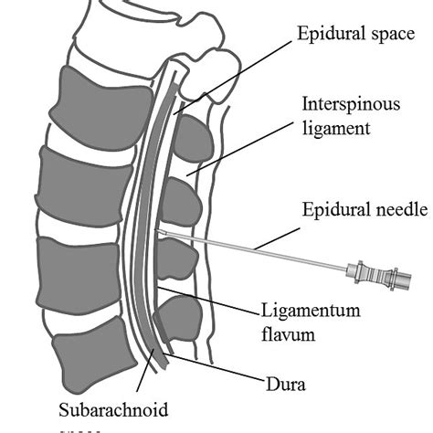 Graphical representation of the epidural space and surrounding anatomy ...