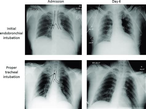 Chest X-ray obtained in a patient with an initial right endobronchial ...