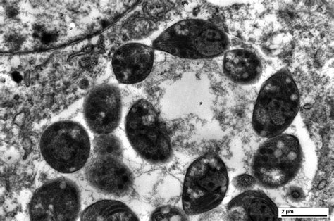 Pathology Outlines - Toxoplasma gondii