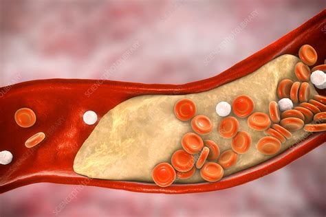 Atheromatous plaque in artery, illustration - Stock Image - F020/9978 - Science Photo Library