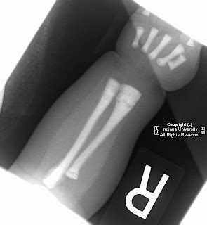 Orthopaedic Surgery CME: X-ray of te day: Osteopetrosis