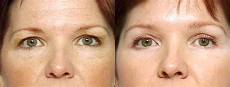 Brow/Forehead Lift Before & After Photo Gallery | Louisville, KY | CaloSpa® Rejuvenation Center