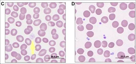 Gray platelet syndrome (GPS) | Medical Laboratories