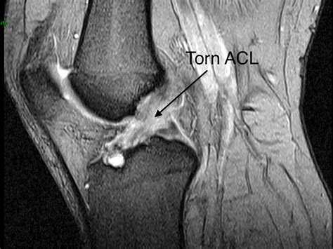 Knee Sports Injury – Anterior Cruciate Ligament (ACL)