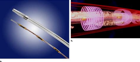 Catheter-directed Thrombolysis with the Endowave System in the ...