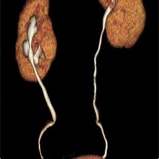 Volume rendering reconstruction of CT scan in 49 year-old woman showing ...