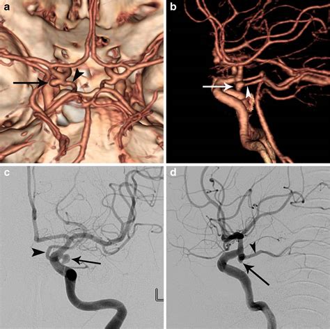 Infundibular dilation and aneurysm at the origin of the posterior ...