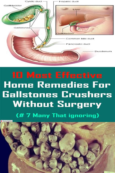 HOW TO DESTROY AND FLUSH ALL GALLSTONES NATURALLY WITHOUT ANY SURGERY - virshealth.blogspot.com