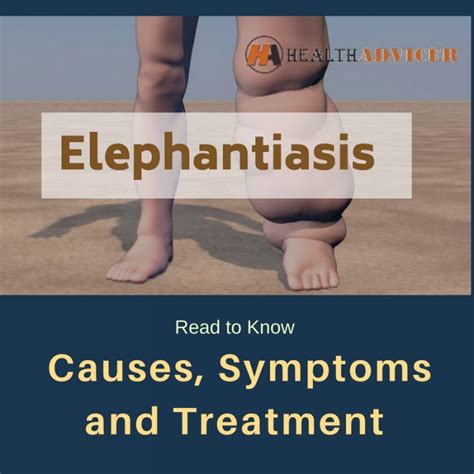 Elephantiasis : Causes, Symptoms, Treatment And Prevention