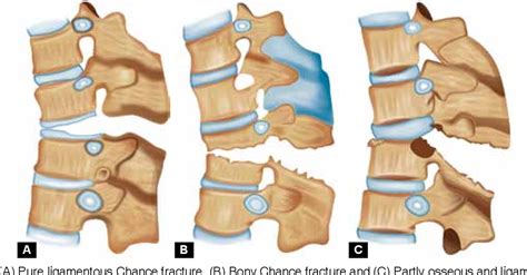 Figure 5 from Missed Chance Fracture of Lumbar Vertebra presenting as Cauda Equina Syndrome: A ...