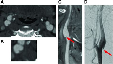 Carotid Webs: Radiographic Appearance and Significance | Ochsner Journal