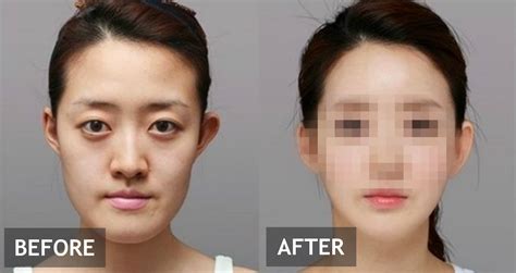 9 Most Popular Plastic Surgery Procedures In Korea - Koreaboo