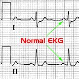 Normal EKG Download