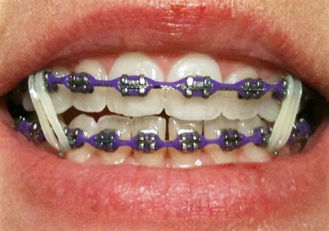 Purple Braces Rubber Bands | Braces | Braces rubber bands, Teeth braces, Braces colors