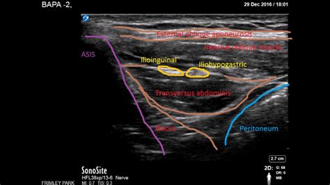 Ilioinguinal Iliohypogastric scanning - YouTube