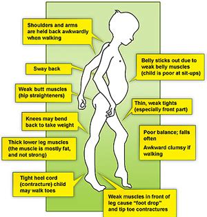 Medical Pictures Info – Duchenne Muscular Dystrophy