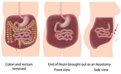 Proctocolectomy surgery for IBD | IBDrelief