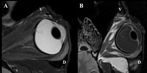 MRI OS, case 2. T2W oblique plane image highlighting the... | Download Scientific Diagram