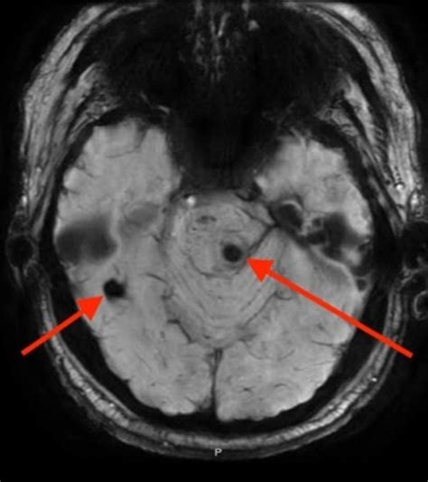 Cureus | Treating Venous Thromboembolism Post Intracranial Hemorrhage: A Case Report