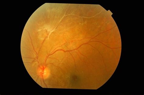 BRVO With Proliferative Retinopathy - Retina Image Bank