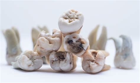 Rotten Teeth: Symptoms, Causes and Treatments