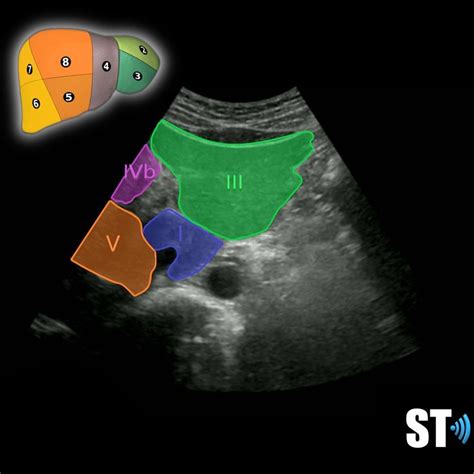 Couinaud’s Liver Segments – Sonographic Tendencies | Segmentation ...