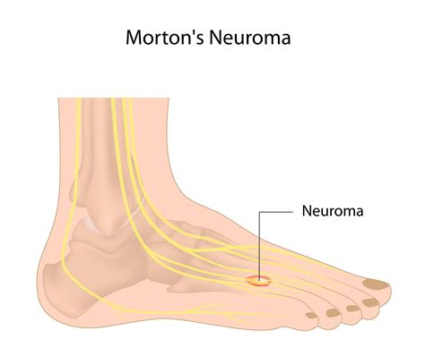 What is Morton’s Neuroma? Causes, Symptoms, and Treatment