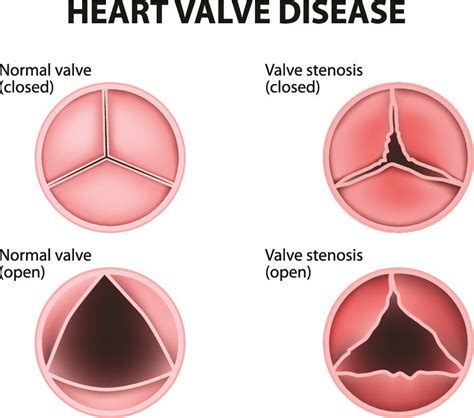 Valvular Heart Disease, Symptoms, and Treatment - Pulse Cardiology