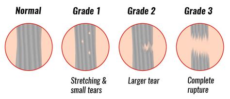 Sprained Ankle - Treatment, Rehabilitation & Exercises