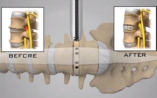 Global XLIF Surgery Market Dominating Industry are NuVasive Inc., RTI Surgical Inc. and K2M,Inc.