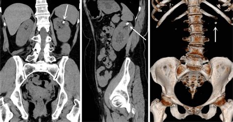 The stone of calyceal diverticulum was located in the upper kidney of ...