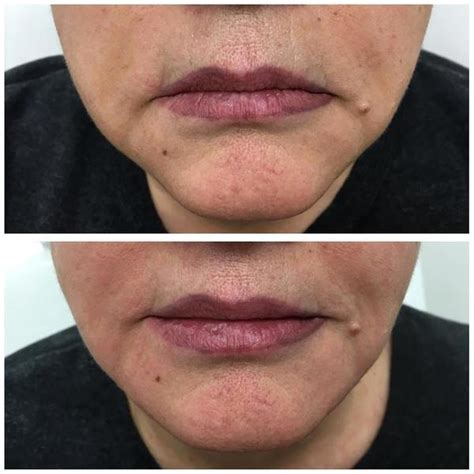 Botox Marionette Lines Before And After (6) » Facial Injections: Info, Prices, Photos, Reviews, Q&A