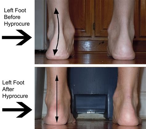 Hyprocure Implant - Flat Feet Corrective Surgery