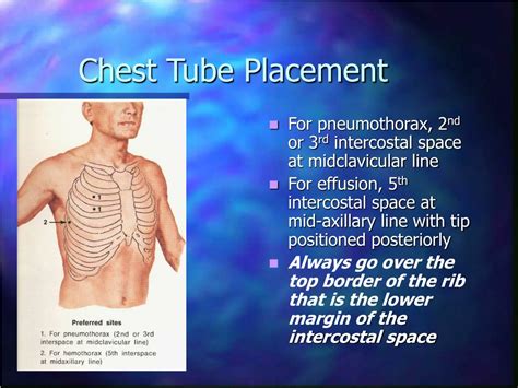 Chest Tube Insertion Uses Procedure And Recovery Chest Tube Tube | Hot Sex Picture