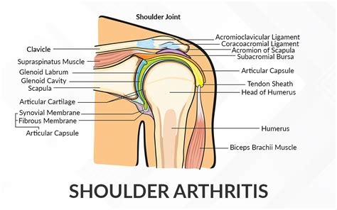 Shoulder Arthritis - Dr. Saurabh Aggarwal