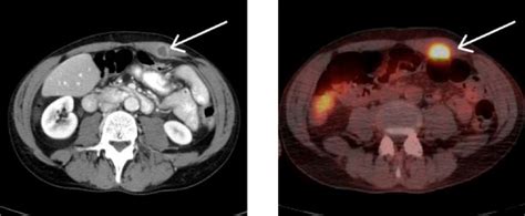 Imaging of left rectus abdominus mass. A.) CT scan performed during ED... | Download Scientific ...