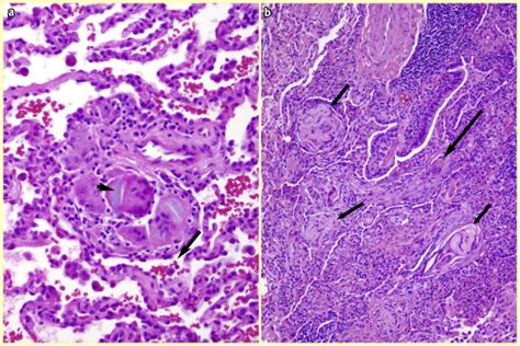 Pulmonary granulomas: differential diagnosis, histologic features and ...