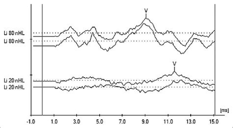 Auditory brainstem response waveforms evoked by 250 Hz tone burst for ...