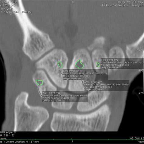 An example of bone erosion of the capitate bone seen on axial (A),... | Download Scientific Diagram