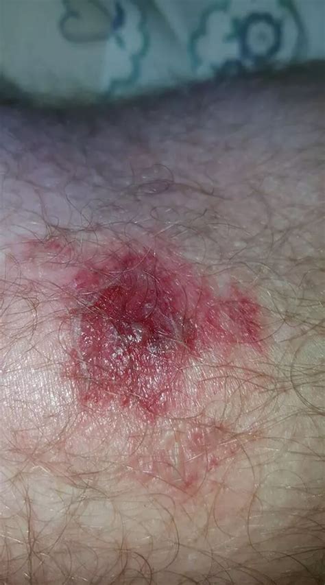 Hull people share their gruesome pictures of painful horsefly bites - Hull Live