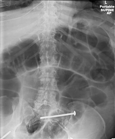 Íleo y obstrucción del intestino delgado | Association LEA