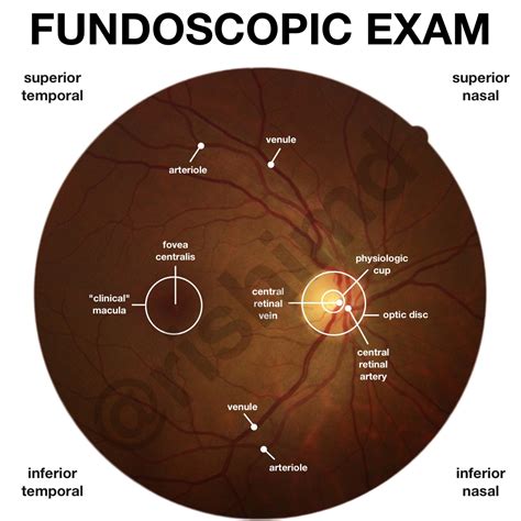 Fundoscopic Examination | RK.MD