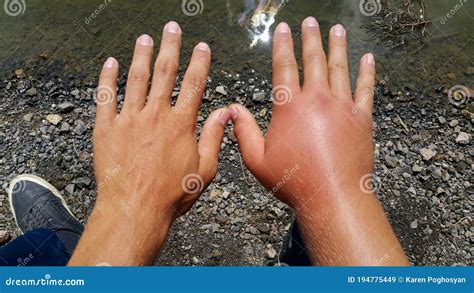 Swollen Hand. Allergy To Bee Stings. Two Hands of a Person Stock Image - Image of dermatitis ...