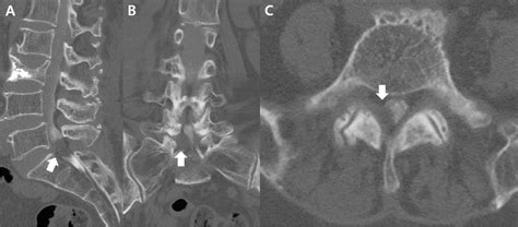 CT-myelogram of the lumbar spine showing a right intra-canalar,... | Download Scientific Diagram