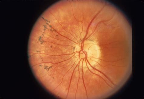 Retinitis Pigmentosa, AR | Hereditary Ocular Diseases